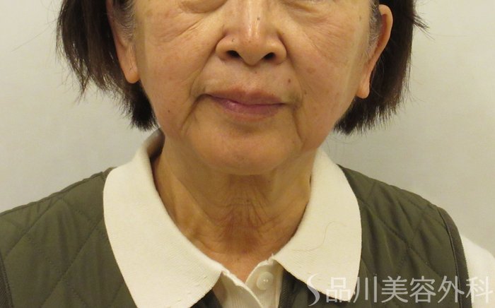 症例NO.72831のBEFORE写真