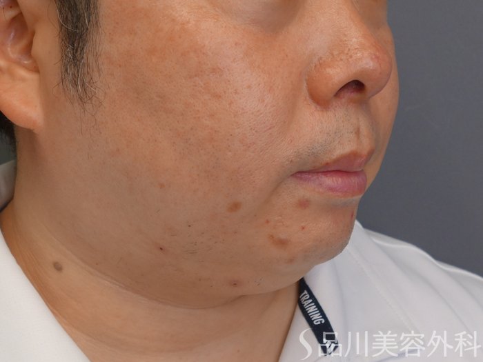 症例NO.75035のBEFORE写真