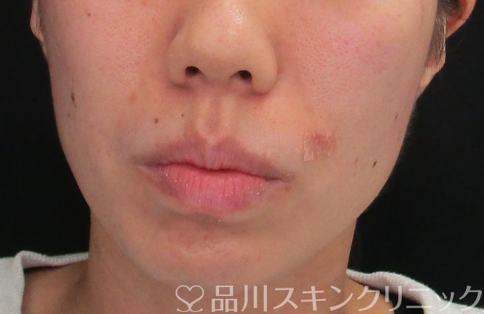 症例NO.73500のAFTER写真