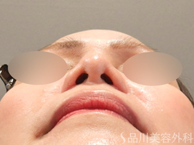 症例NO.71796のAFTER写真