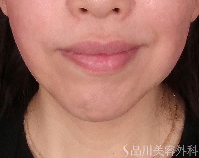 症例NO.69958のAFTER写真