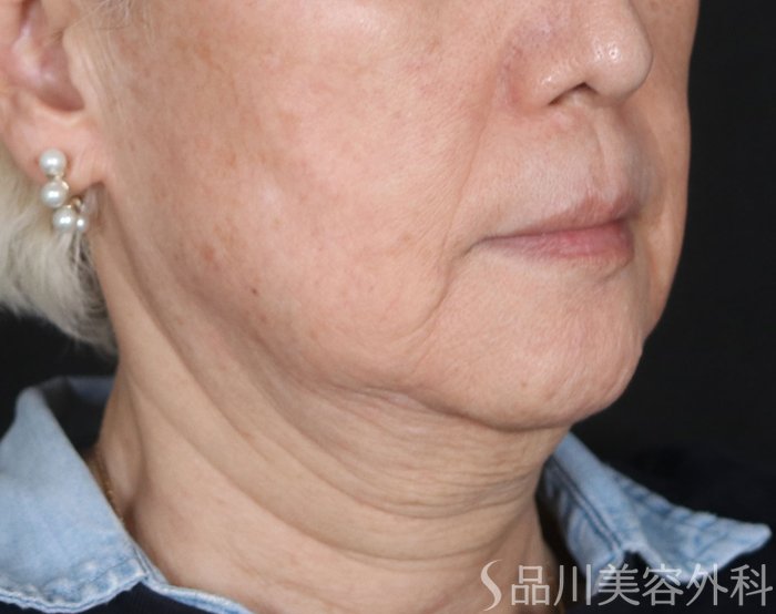 症例NO.73729のBEFORE写真