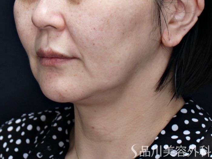 症例NO.71633のBEFORE写真