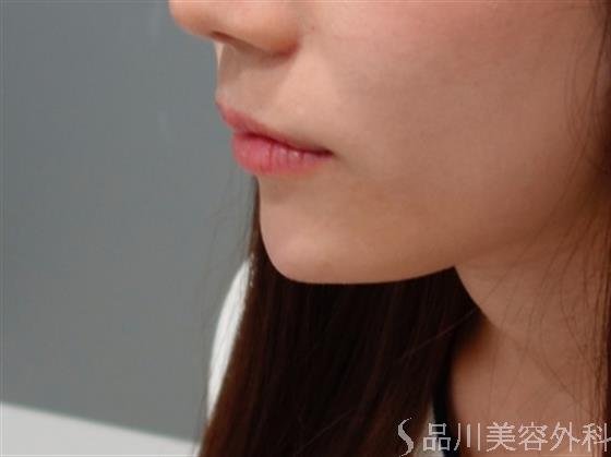 症例NO.50616のAFTER写真