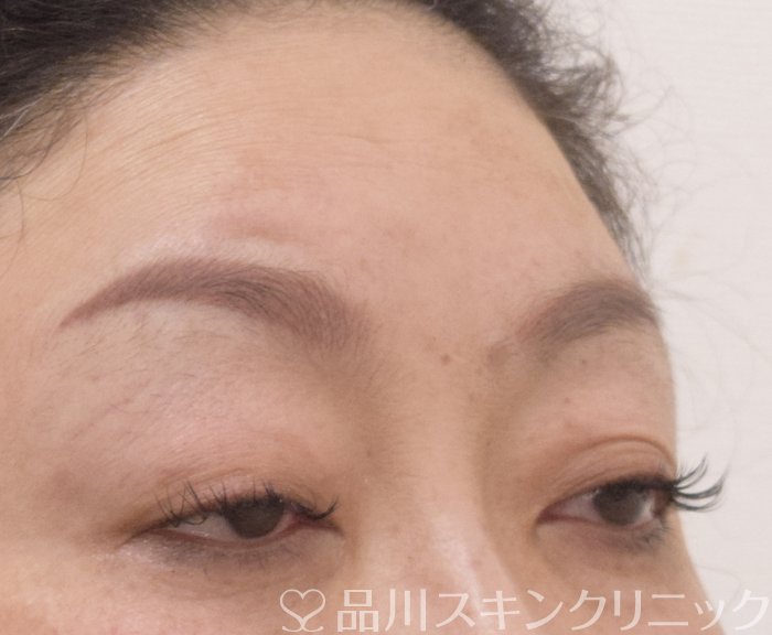 症例NO.75255のBEFORE写真