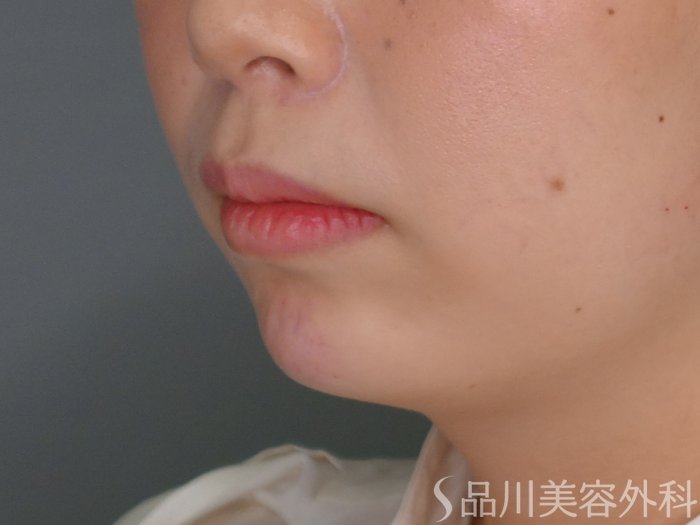 症例NO.69844のAFTER写真