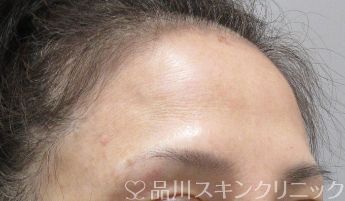症例NO.74418のBEFORE写真