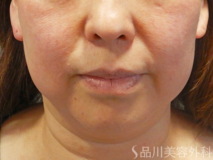 症例NO.70443のBEFORE写真