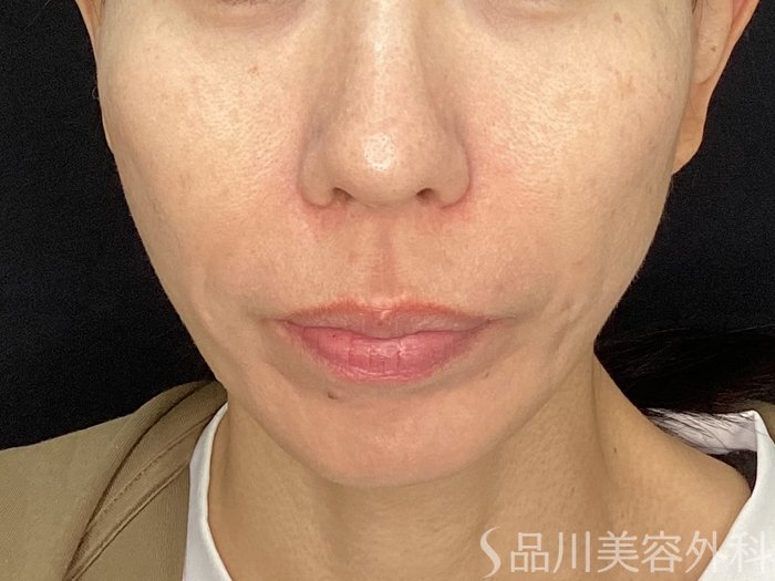 症例NO.72733のAFTER写真