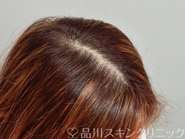 症例NO.69587のAFTER写真