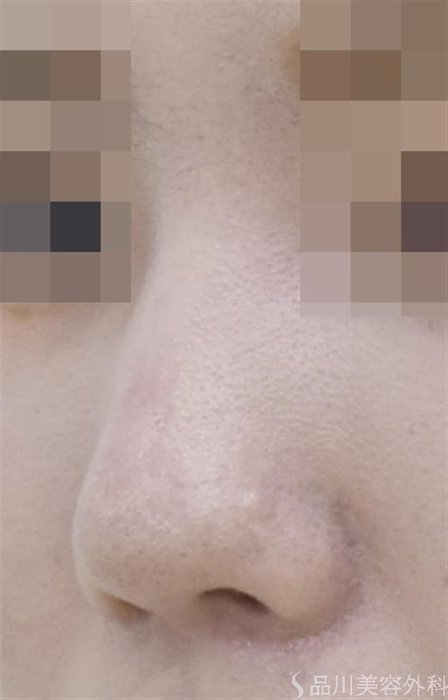症例NO.52913のAFTER写真