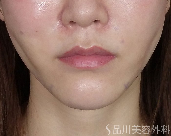 症例NO.73301のAFTER写真