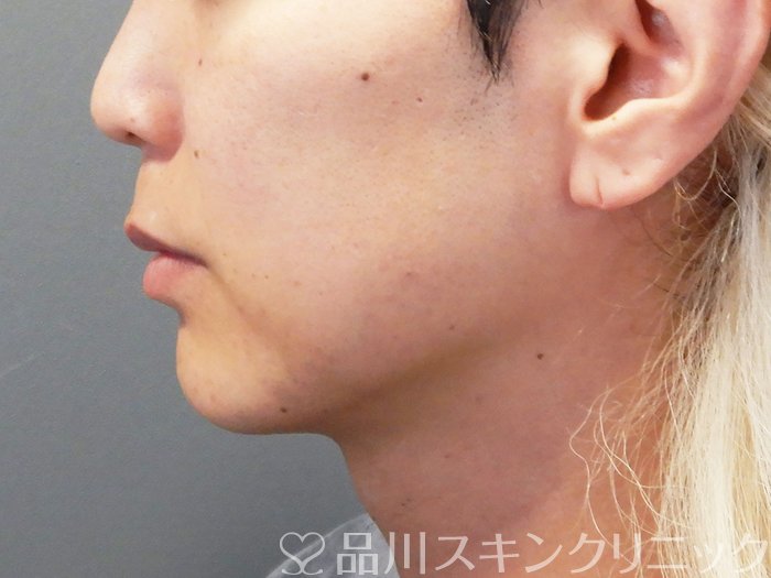症例NO.74370のBEFORE写真