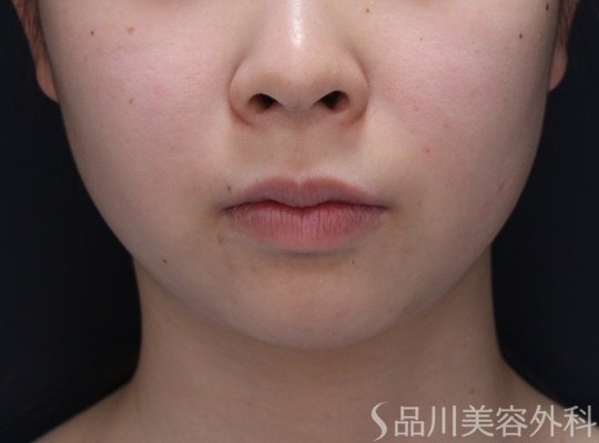 症例NO.67701のBEFORE写真