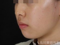 症例NO.72533のBEFORE写真