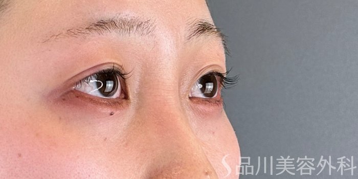 症例NO.69718のAFTER写真