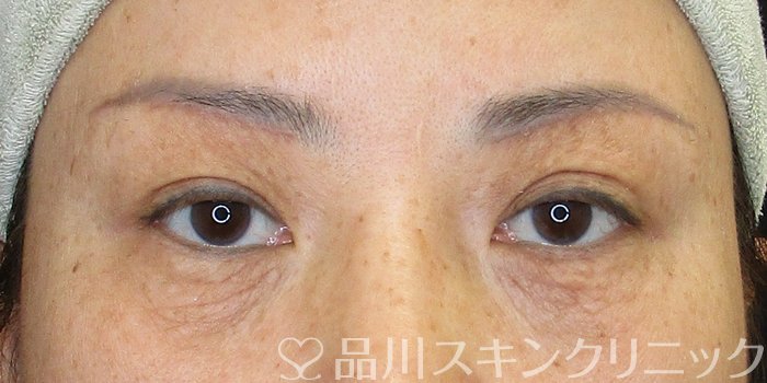 症例NO.73645のAFTER写真