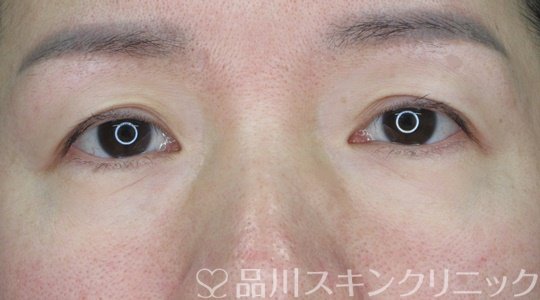 症例NO.69463のBEFORE写真