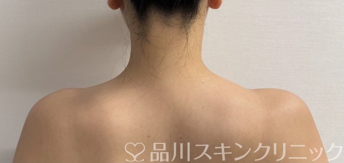 症例NO.69975のAFTER写真