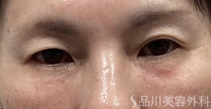 症例NO.68153のAFTER写真