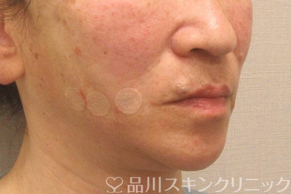 症例NO.75165のAFTER写真