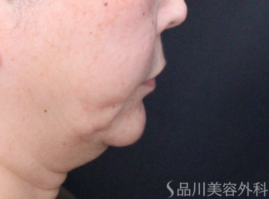 症例NO.74903のBEFORE写真