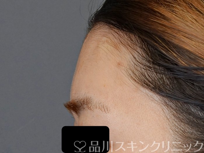 症例NO.72698のAFTER写真