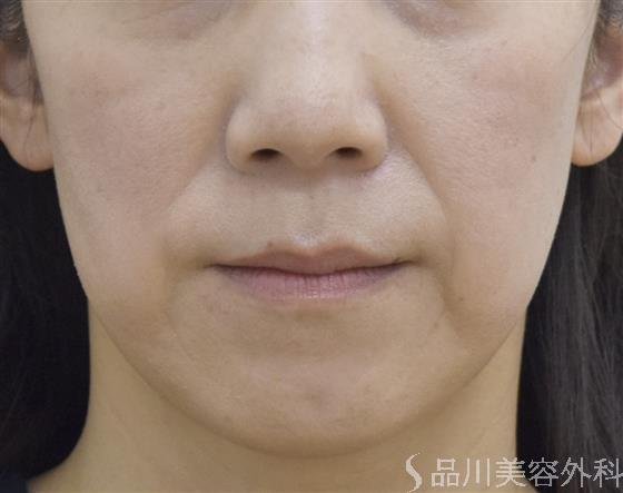 症例NO.54825のBEFORE写真