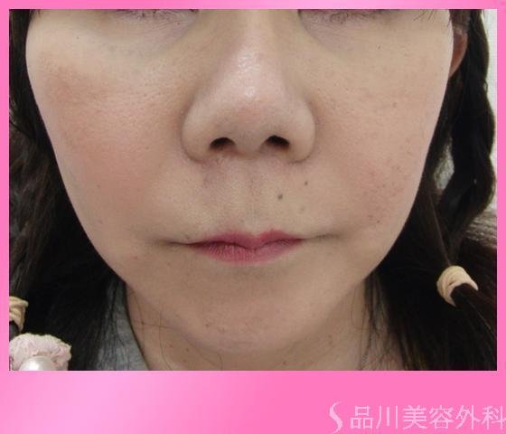 症例NO.2531のAFTER写真