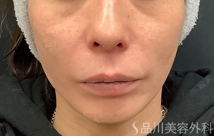 症例NO.69485のAFTER写真