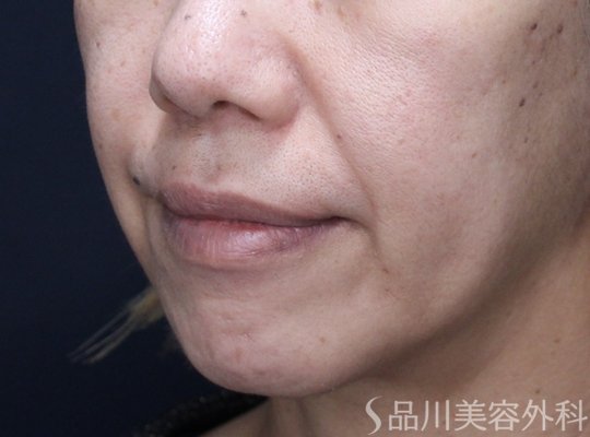 症例NO.73347のBEFORE写真