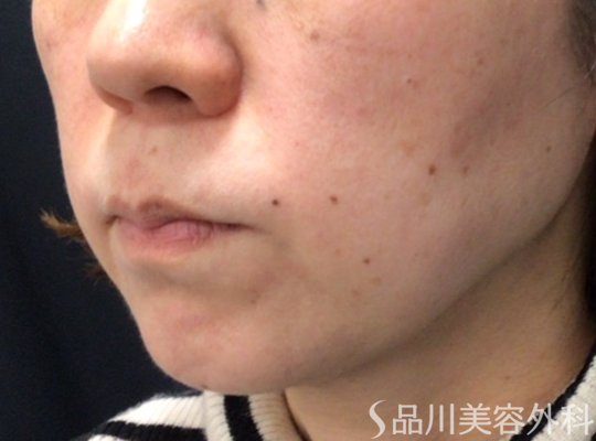 症例NO.74525のBEFORE写真