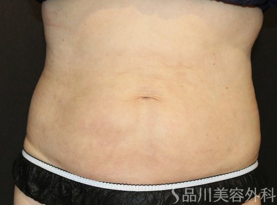 症例NO.73801のAFTER写真