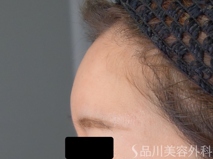 症例NO.68348のAFTER写真