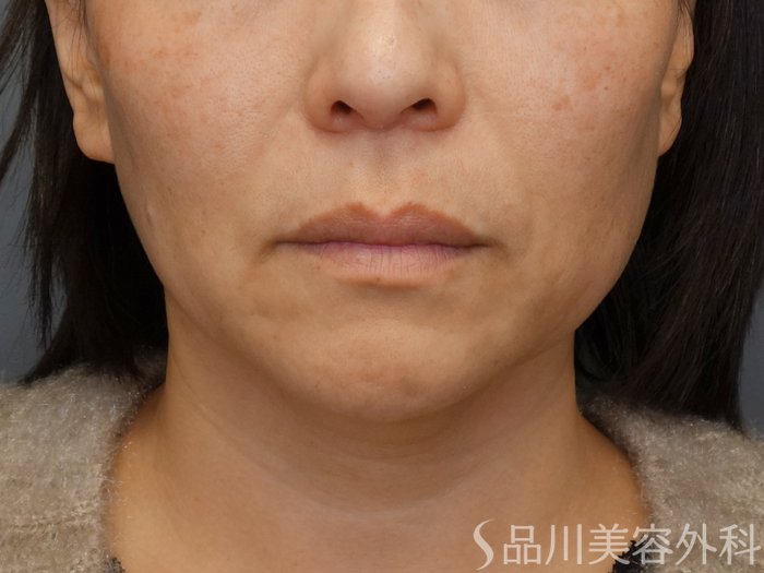 症例NO.72650のBEFORE写真