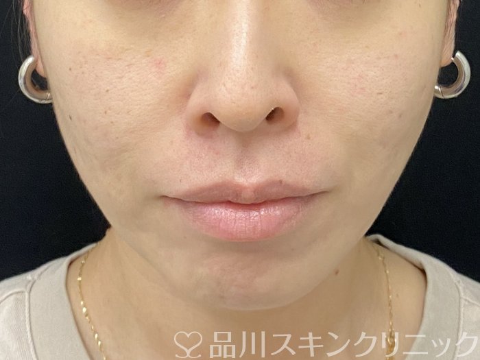 症例NO.74915のAFTER写真