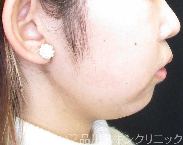 症例NO.68981のBEFORE写真