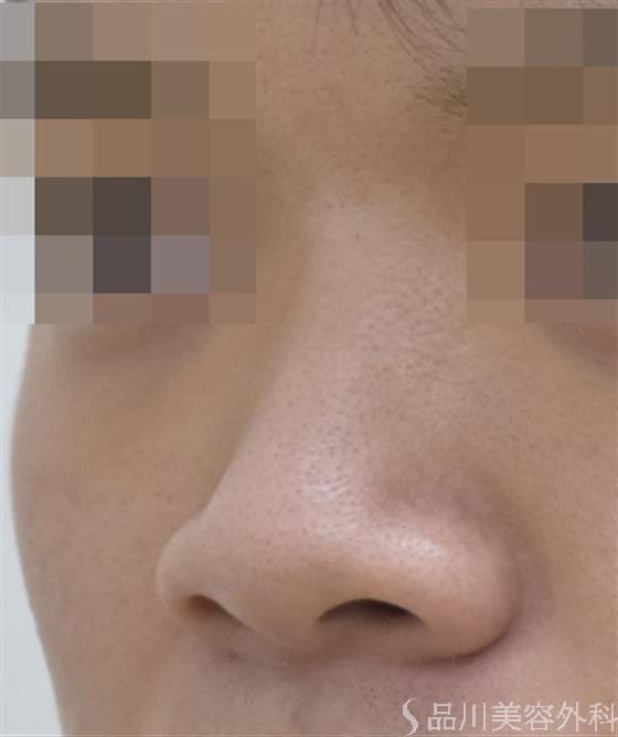 症例NO.48137のBEFORE写真