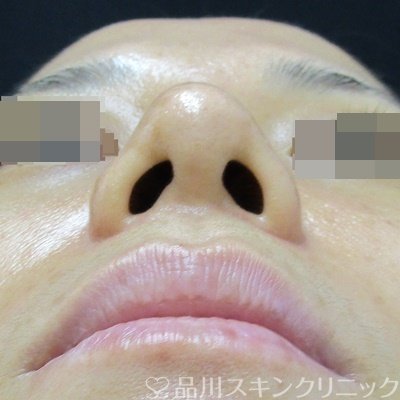 症例NO.71707のAFTER写真