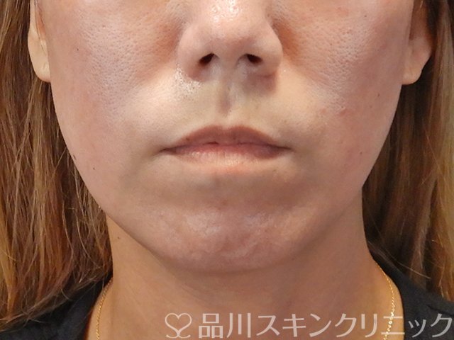 症例NO.75039のBEFORE写真