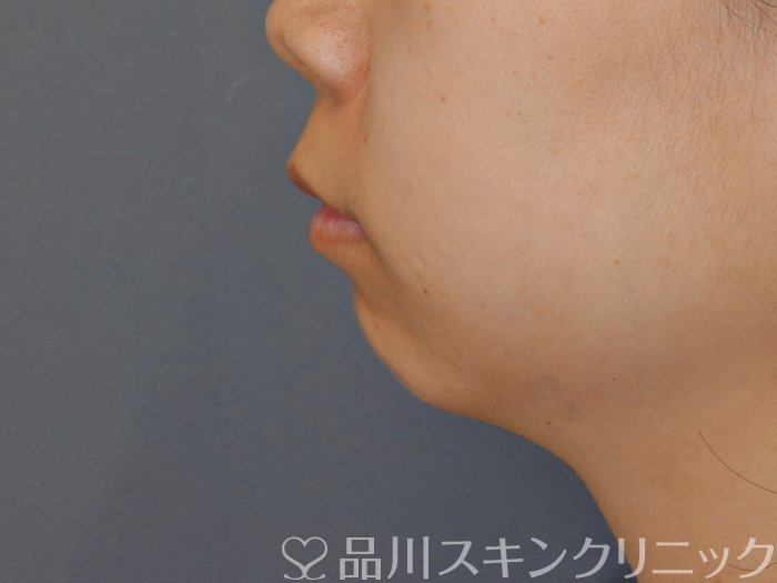 症例NO.71745のBEFORE写真