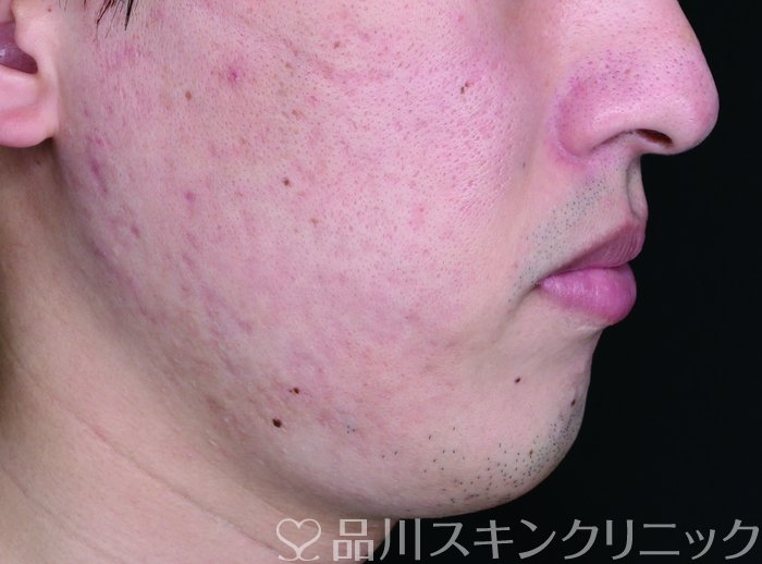 症例NO.65071のBEFORE写真
