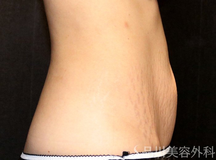 症例NO.70097のAFTER写真