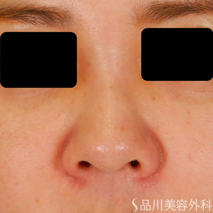 症例NO.69310のBEFORE写真