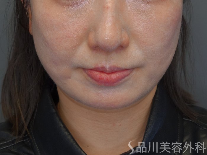 症例NO.74815のBEFORE写真
