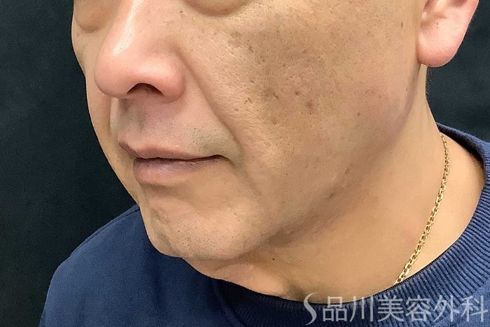 症例NO.69615のBEFORE写真