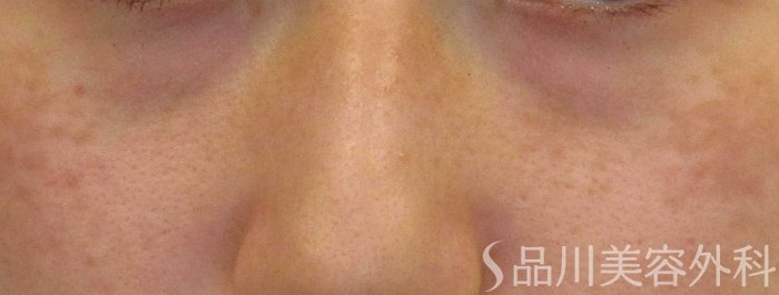 症例NO.65474のBEFORE写真
