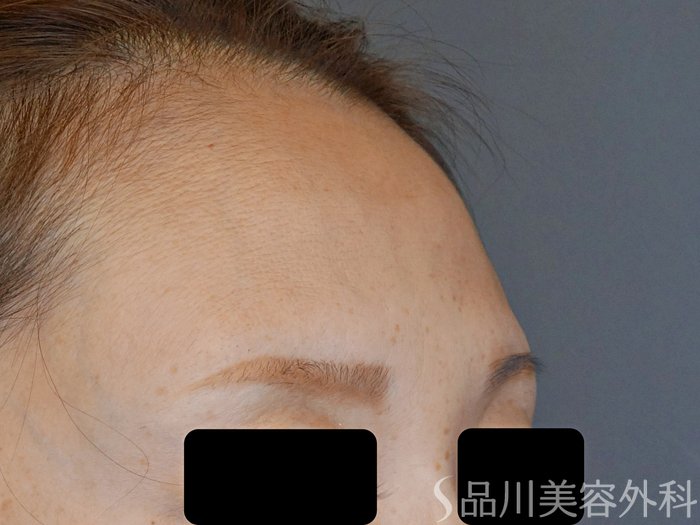 症例NO.72105のBEFORE写真