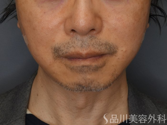 症例NO.72036のAFTER写真