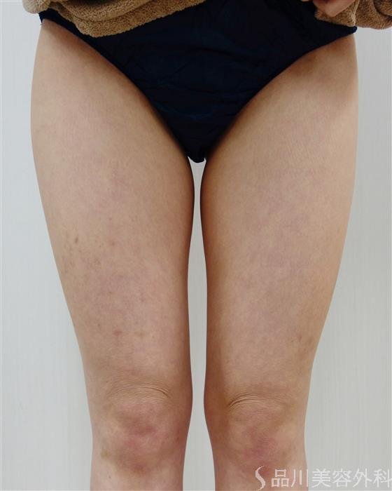 症例NO.50701のBEFORE写真
